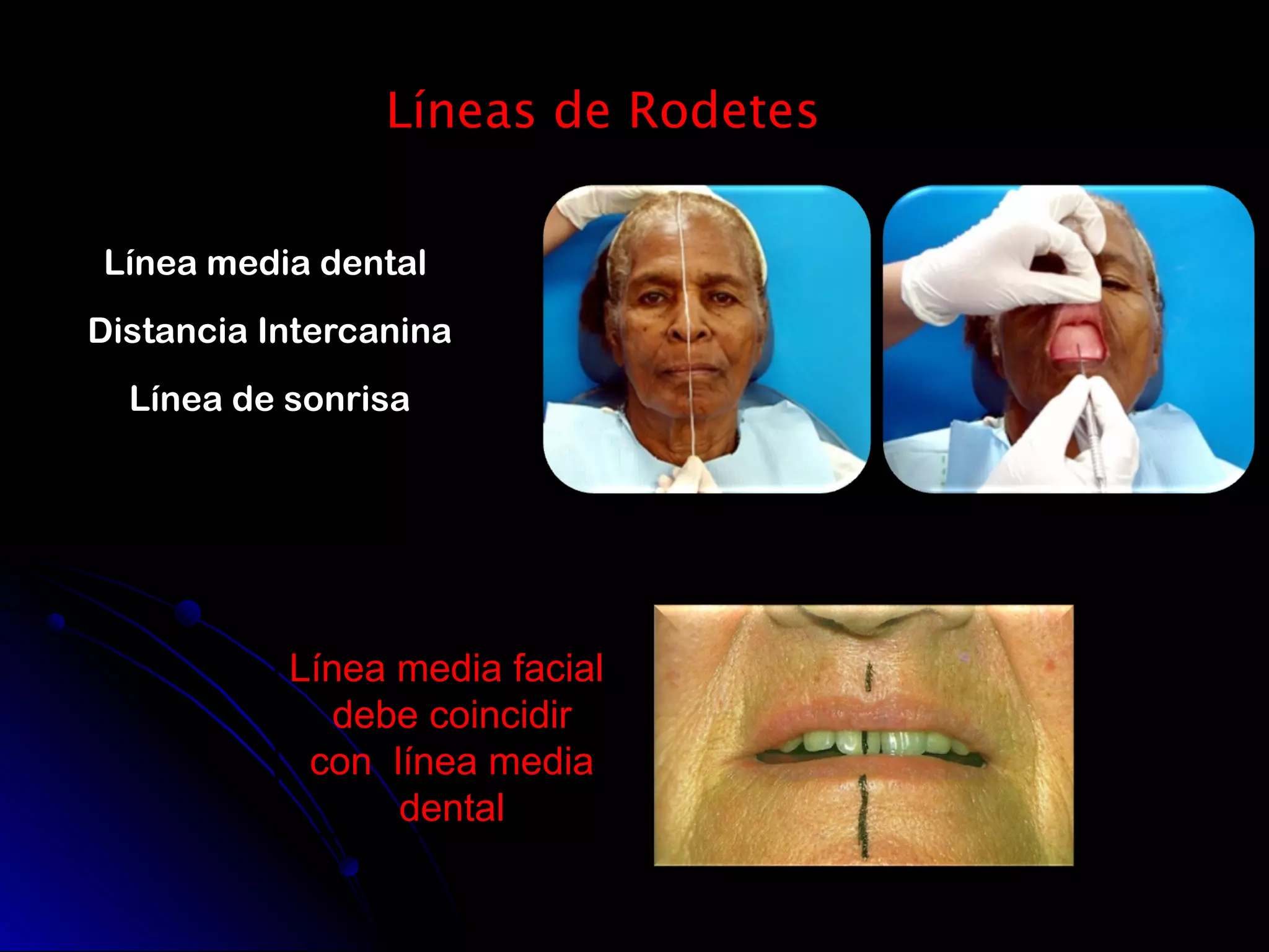 Prueba de rodetes y registros en protesis total | PPT