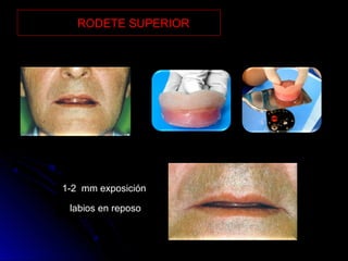 Prueba de rodetes y registros en protesis total | PPT