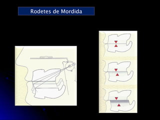 Prueba de rodetes y registros en protesis total | PPT