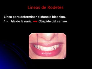 Prueba de rodetes y registros en protesis total | PPT