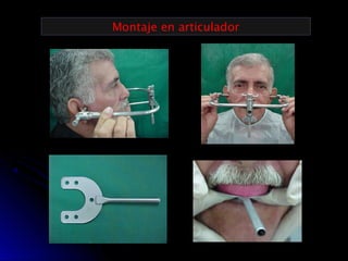 Prueba de rodetes y registros en protesis total | PPT