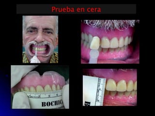 Prueba de rodetes y registros en protesis total | PPT