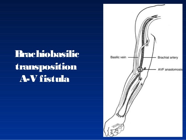 Brachiocephalic Fistula Anatomy