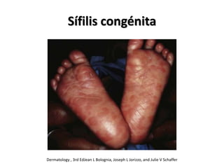 Sífilis congénita
Dermatology , 3rd EdJean L Bolognia, Joseph L Jorizzo, and Julie V Schaffer
 