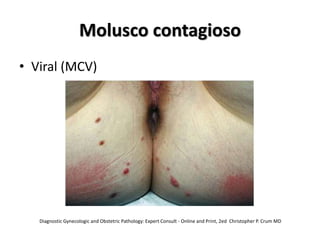 Molusco contagioso
• Viral (MCV)
Diagnostic Gynecologic and Obstetric Pathology: Expert Consult - Online and Print, 2ed Christopher P. Crum MD
 