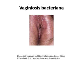 Vaginiosis bacteriana
Diagnostic Gynecologic and Obstetric Pathology , Second Edition
Christopher P. Crum, Marisa R. Nucci, and Kenneth R. Lee
 