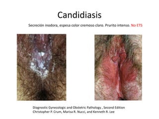 Candidiasis
Secreción inodora, espesa color cremoso claro. Prurito intenso. No ETS
Diagnostic Gynecologic and Obstetric Pathology , Second Edition
Christopher P. Crum, Marisa R. Nucci, and Kenneth R. Lee
 