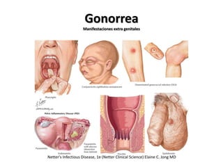Gonorrea
Manifestaciones extra genitales
Netter's Infectious Disease, 1e (Netter Clinical Science) Elaine C. Jong MD
 