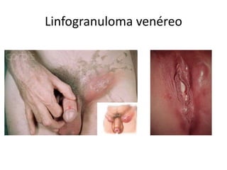 Linfogranuloma venéreo
 