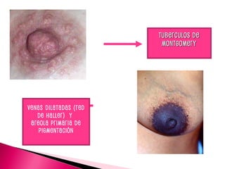 Tuberculos de
Tuberculos de
Montgomery
Montgomery
Venas dilatadas (Red
de Haller) y
areola primaria de
pigmentación
 