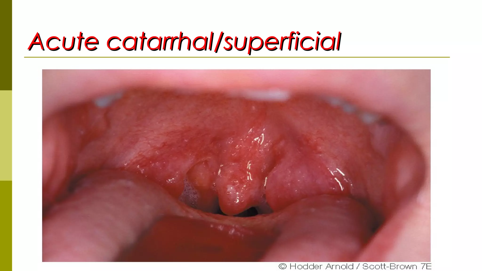 Acute catarrhal/superficialAcute catarrhal/superficial
 