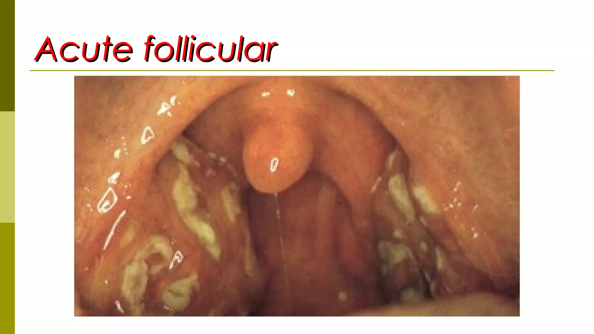 Acute follicularAcute follicular
 