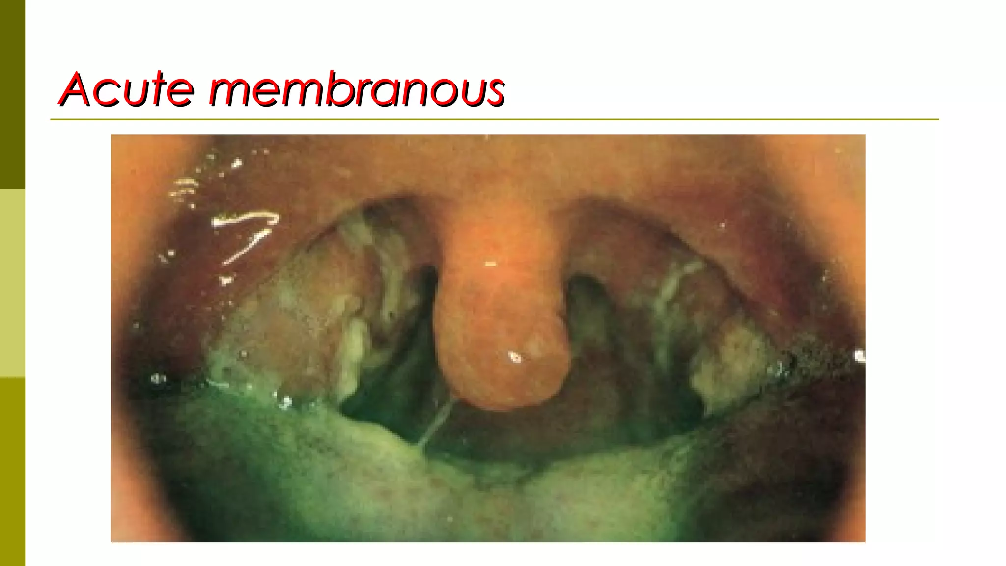 Acute membranousAcute membranous
 