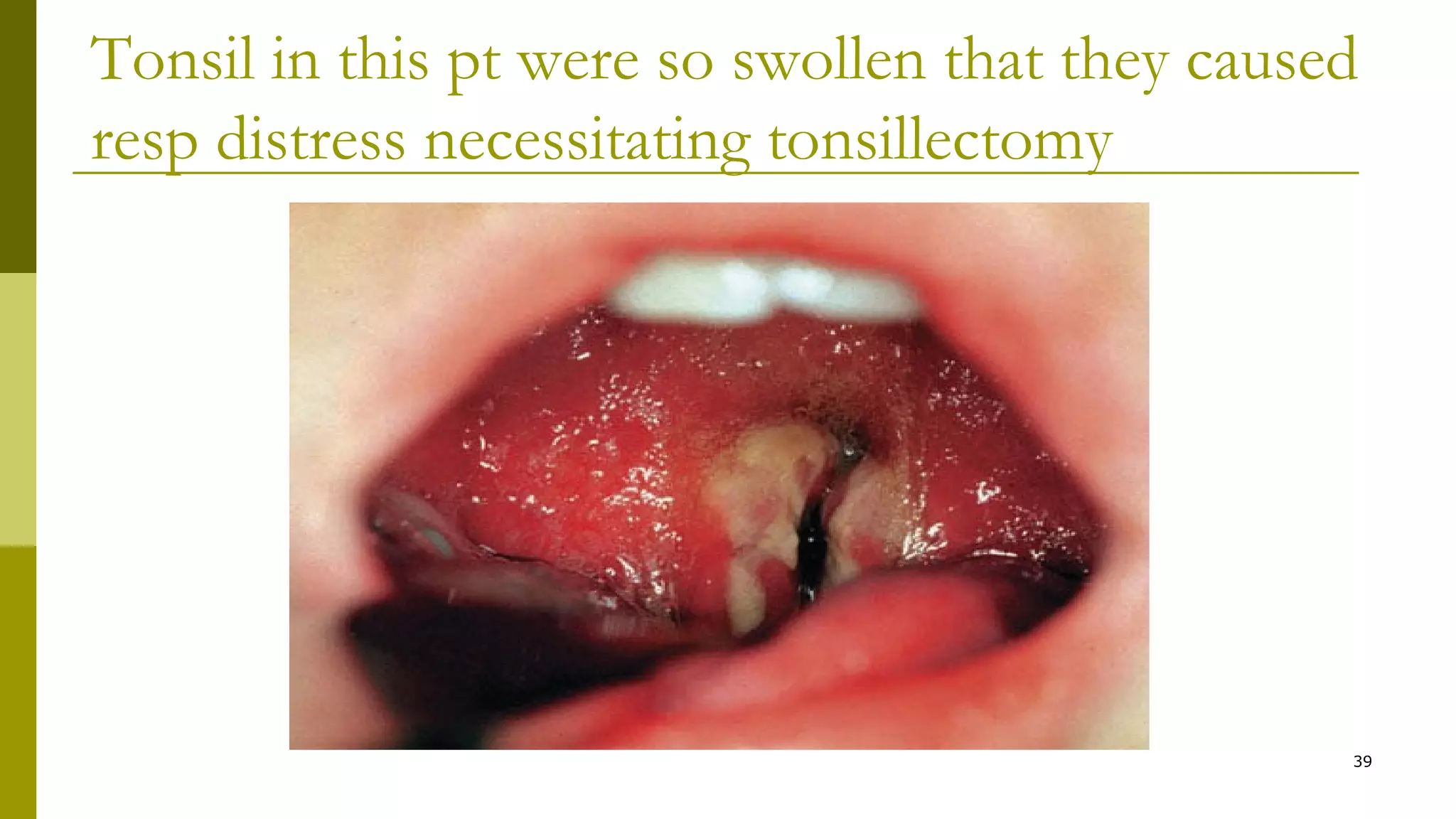Tonsil in this pt were so swollen that they caused
resp distress necessitating tonsillectomy
39
 