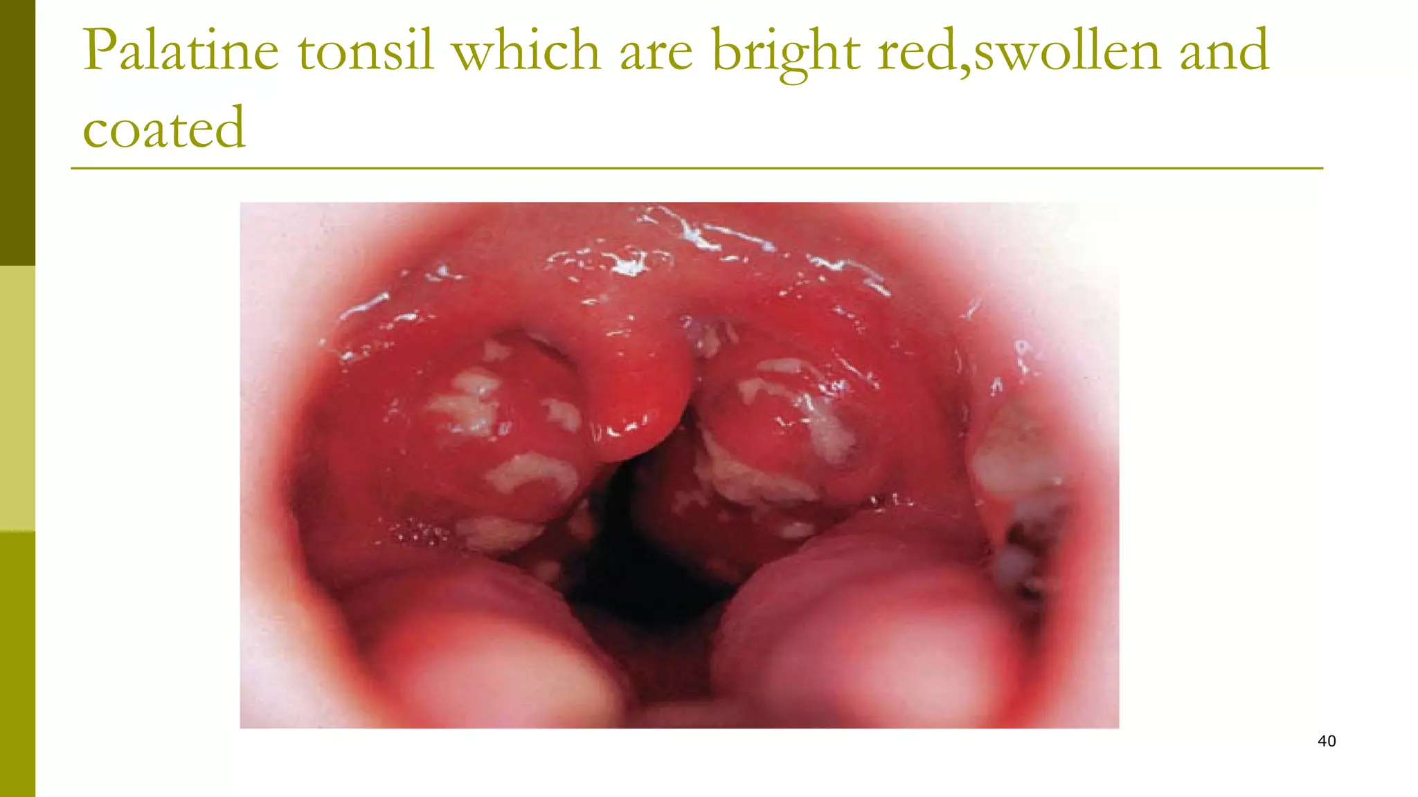 Palatine tonsil which are bright red,swollen and
coated
40
 