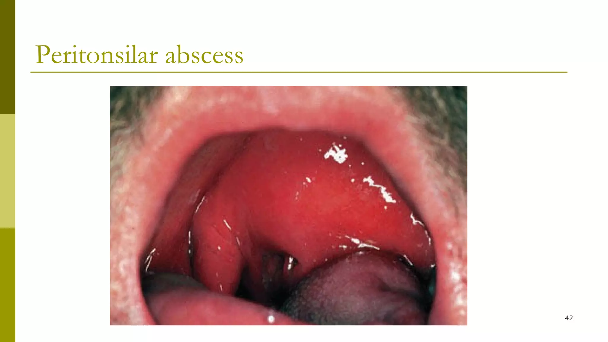 Peritonsilar abscess
42
 
