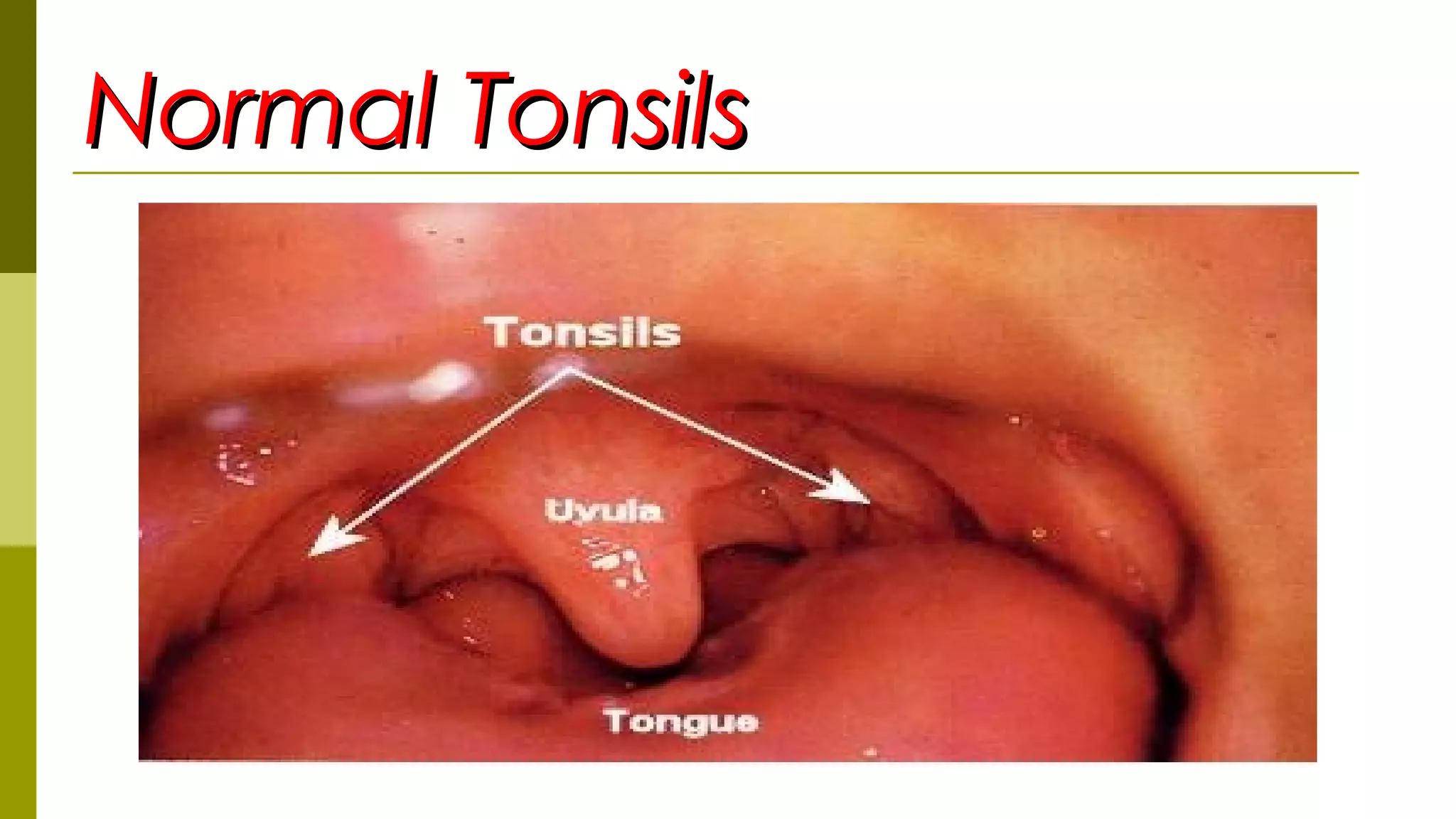Normal TonsilsNormal Tonsils
 