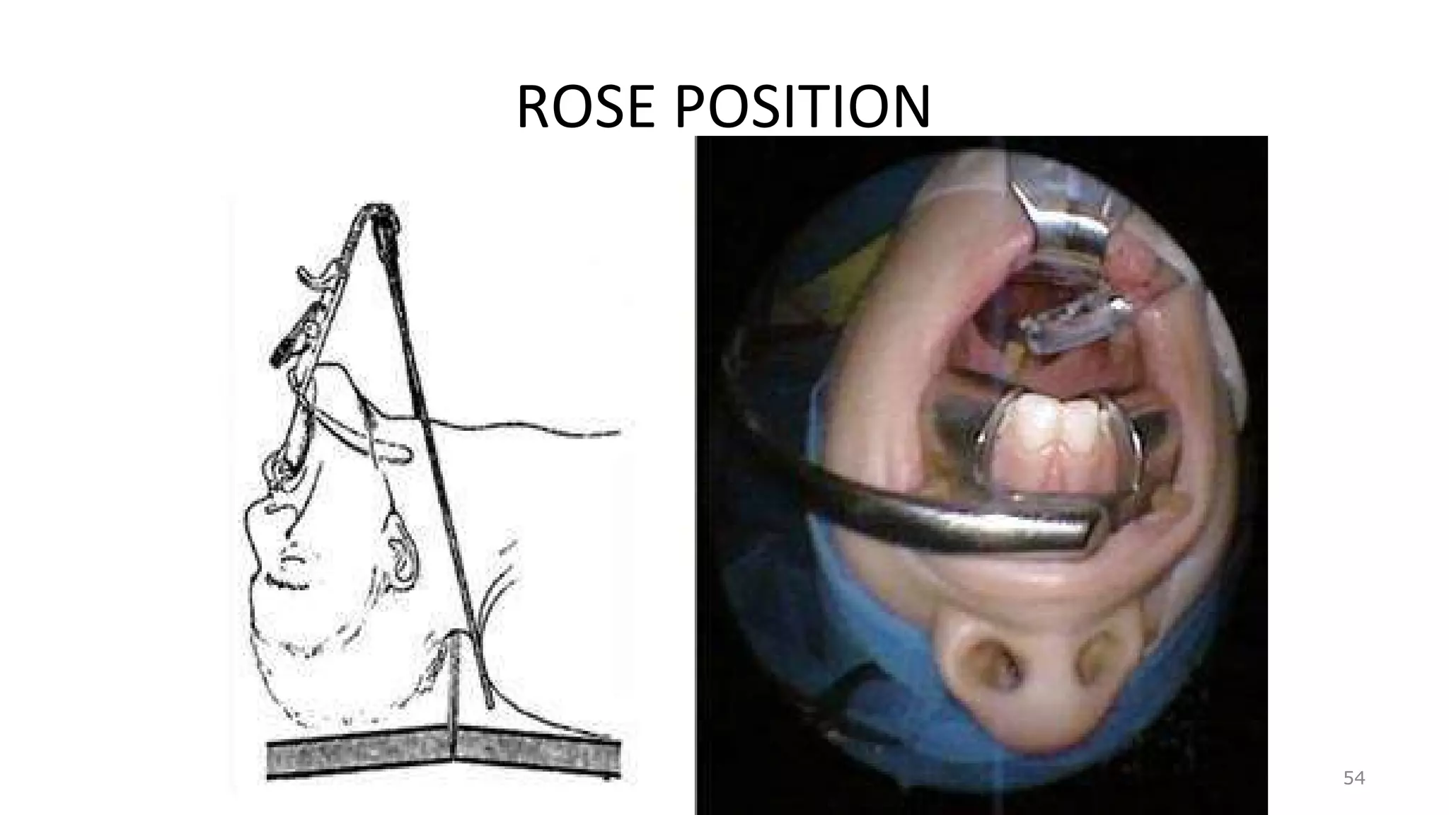 ROSE POSITION
54
 