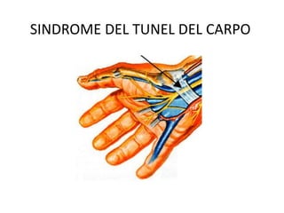 SINDROME DEL TUNEL DEL CARPO
 