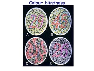 104
Colour blindness
 