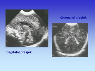 Sagitalni presjek 
Koronarni presjek  