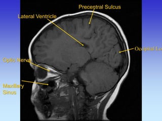 Optic Nerve Maxillary Sinus 
Precentral Sulcus 
Lateral Ventricle 
Occipital Lobe  