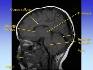 Caudate 
Nucleus 
Tongue 
Corpus callosum 
Thalamus 
Tentorium 
Cerebelli 
Pons  