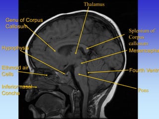 Thalamus 
Splenium of Corpus callosum 
Pons 
Ethmoid air Cells Inferior nasal Concha 
Mesencephalon 
Fourth Ventricle 
Genu of Corpus 
Callosum 
Hypophysis  