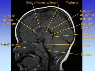 Body of corpus callosum Thalamus 
Splenium of Corpus callosum 
Genu of corpus callosum 
Pons 
Superior Colliculus 
Inferior 
Colliculus 
Nasal 
Septuml 
Medulla  
