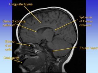 Cingulate Gyrus 
Genu of corpus callosum 
Ethmoid air cells 
Oral cavity 
Splenium of Corpus callosum 
Fourth Ventricle  