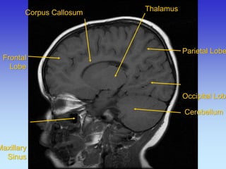Frontal 
Lobe 
Maxillary 
Sinus 
Parietal Lobe Occipital Lobe 
Corpus Callosum 
Thalamus 
Cerebellum  