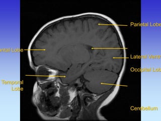 Frontal Lobe 
Temporal 
Lobe 
Parietal Lobe Lateral Ventricle Occipital Lobe Cerebellum  