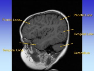 Parietal Lobe 
Occipital Lobe 
Cerebellum 
Frontal Lobe Temporal Lobe  