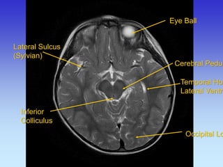 Eye Ball 
Cerebral Peduncle 
Temporal Horn Lateral Ventricle 
Occipital Lobe 
Lateral Sulcus (Sylvian) 
Inferior Colliculus  