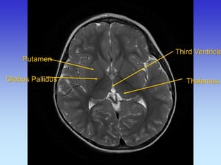 Putamen 
Globus Pallidus 
Third Ventricle 
Thalamus  