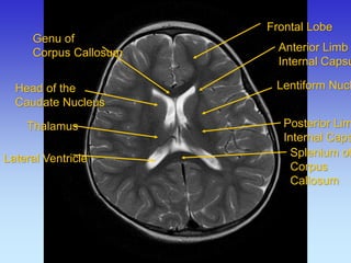 Frontal Lobe 
Anterior Limb 
Internal Capsule 
Lentiform Nucleus 
Posterior Limb 
Internal Capsule 
Splenium of Corpus Callosum 
Genu of 
Corpus Callosum 
Head of the Caudate Nucleus 
Thalamus 
Lateral Ventricle  