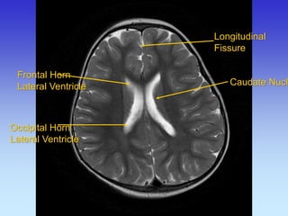 Longitudinal Fissure 
Caudate Nucleus 
Frontal Horn Lateral Ventricle 
Occipital Horn 
Lateral Ventricle  