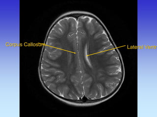 Lateral Ventricle 
Corpus Callosum  