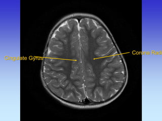 Cingulate Gyrus 
Corona Radiata  