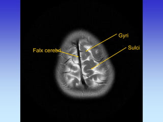 Gyri 
Sulci 
Falx cerebri  