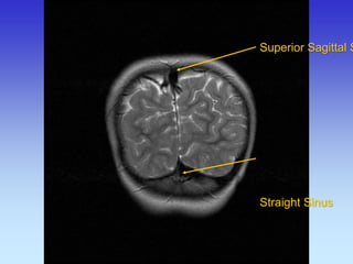 Superior Sagittal Sinus 
Straight Sinus  