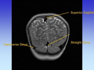 Transverse Sinus 
Superior Sagittal Straight Sinus  
