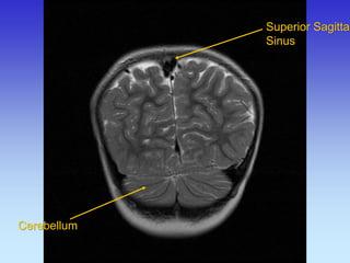 Cerebellum 
Superior Sagittal Sinus  