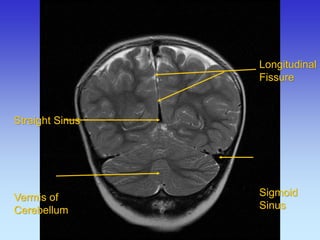 Longitudinal 
Fissure 
Sigmoid 
Sinus 
Straight Sinus Vermis of Cerebellum  