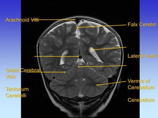 Arachnoid Villi 
Great Cerebral 
Vein 
Tentorium 
Cerebelli 
Falx Cerebri Lateral Ventricle Vermis of Cerebellum Cerebellum  