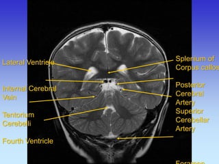 Splenium of Corpus callosum Posterior Cerebral Artery Superior Cerebellar Artery Foramen Lateral Ventricle 
Internal Cerebral 
Vein 
Tentorium 
Cerebelli 
Fourth Ventricle  