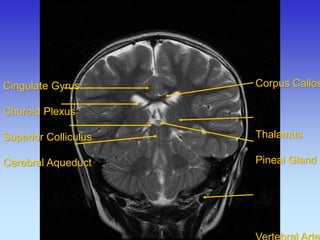 Cingulate Gyrus Choroid Plexus Superior Colliculus Cerebral Aqueduct 
Corpus Callosum Thalamus Pineal Gland Vertebral Artery  