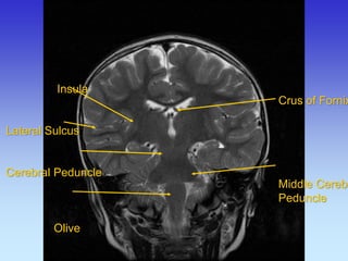 Insula Lateral Sulcus Cerebral Peduncle Olive 
Crus of Fornix 
Middle Cerebellar 
Peduncle  