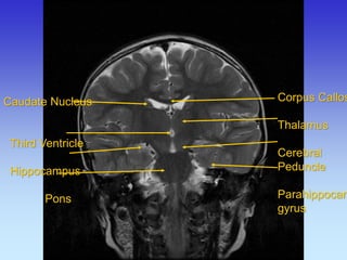 Caudate Nucleus 
Third Ventricle 
Hippocampus 
Pons 
Corpus Callosum Thalamus Cerebral Peduncle Parahippocampal gyrus  