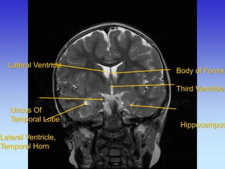 Lateral Ventricle Uncus Of Temporal Lobe Lateral Ventricle, Temporal Horn 
Body of Fornix 
Third Ventricle 
Hippocampus  